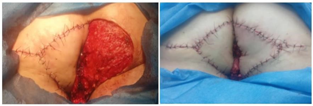 Figure 2: A) Wide local resection with oncologic margins. B) Bilateral V/Y flap reconstruction with 90% coverage of the defect. 