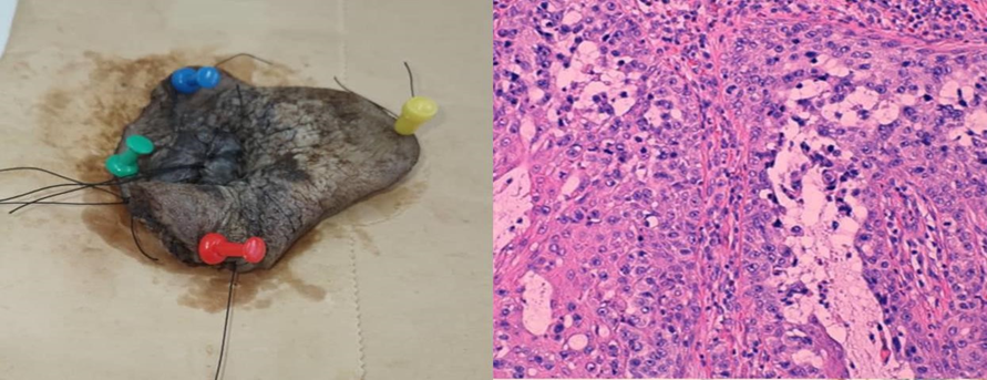 Figure 4: A) Biopsy specimen, disease free margins. B) Pategoid cells, ample cytoplasm, atypical nuclei with small nucleoli. 