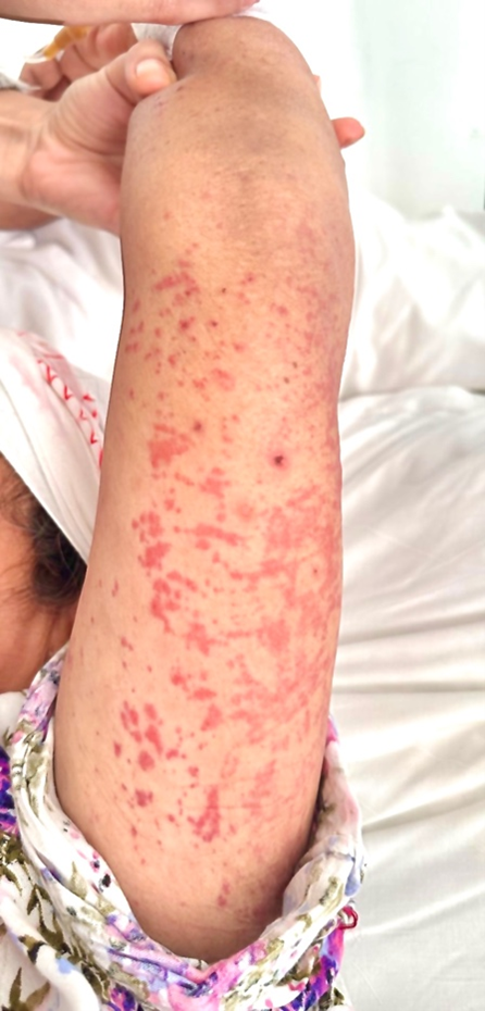 Figure 1: Image representing our patient’s upper limb maculopapular rash.