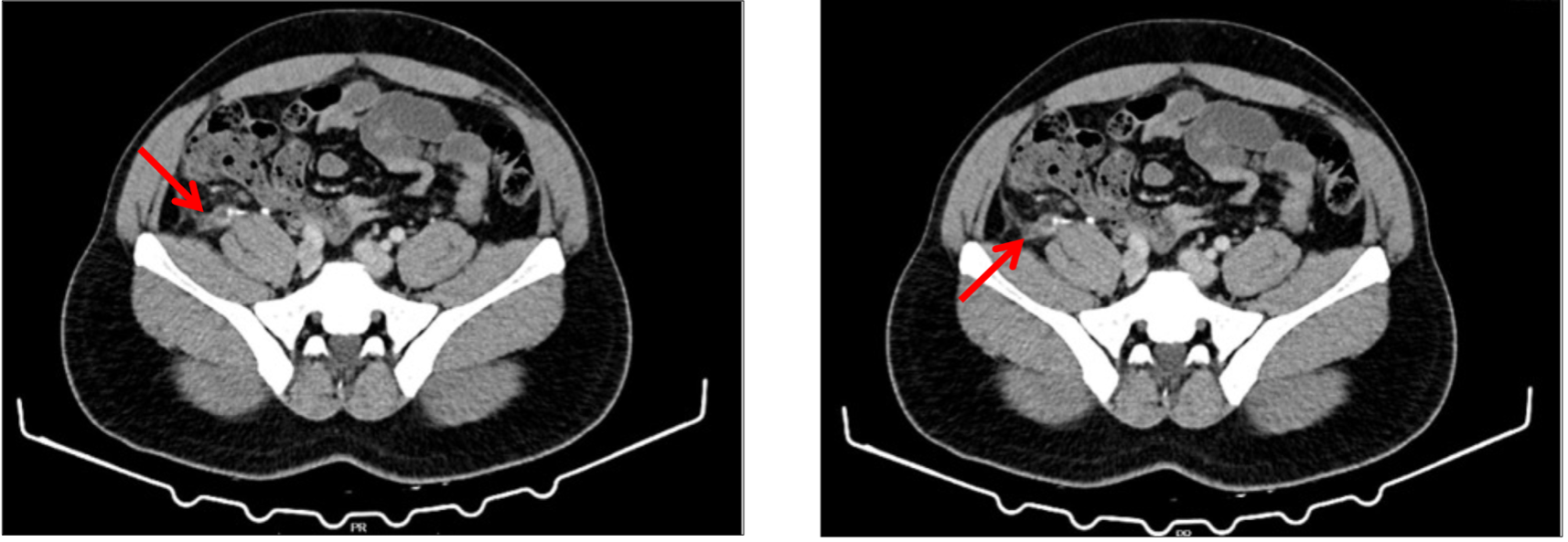 Figure 1: Abdominopelvic CT scan, axial view, reporting a tubular image compatible with an appendicular stump, and an edematous thickening of the peritoneum/fascias on the right flank and right iliac fossa, suggesting a stump appendicitis (red arrow).