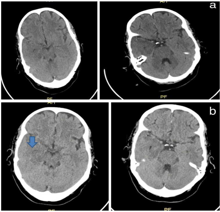 Figure 1: Axial Brain CT show hypoattenuation (darkness) of the brain parenchyma; loss of grey matter-white matter
differentiation in the right fronto-temporal area. (a) Post admission day-1 (b) post admission day-2.