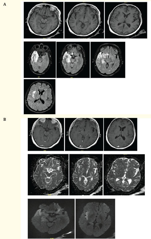 Figure 2A, B: Axial brain MRI show an ill-defined (predominantly cortical) area of abnormal signal intensity involving the right temporal lobe, right hippocampus, the posterior portion of right gyrus rectus and right insula, being hyperintense at both T2WI and FLAIR (blue arrow), hypo-intense at T1WI, with gyral swelling and diffusion restriction (prominent at insular region) (arrow head) with positive mass effect in the form of effacement of ipsilateral cortical sulci and sylvian fissure. Sparing of the right basal ganglia structures is seen. The left hippocampus also shows a subtle area of increased T2/FLAIR signal, with no diffusion restriction. Left fronto-parietal small white matter foci of abnormal signal being hyperintense at both T2 and FLAIR WI, isointense at T1WI, shows no diffusion restriction, no significant mass effect or peri-lesionsal edema. Post contrast study revealed subtle patchy enhancement of the involved region, associated with mild linear lepto-meningeal enhancement extending to the adjacent portions of the right parietal lobe