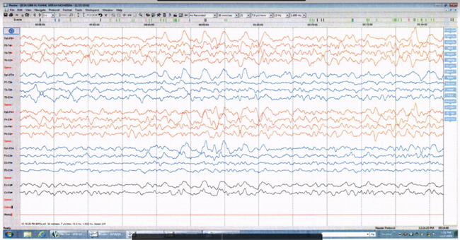 Figure 3b: EEG done 2 weeks later showed no more BLEDS but there is infrequent right temporal sharp waves (blue arrows).