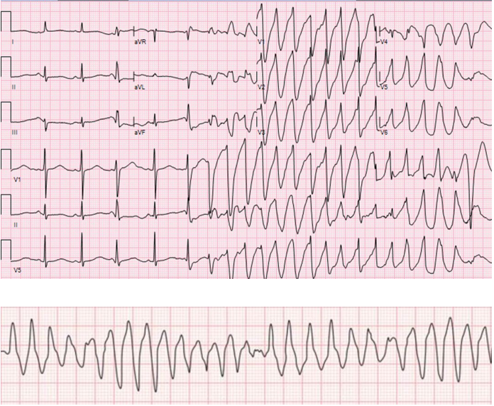 Figure 1: ECG taken during episode of cardiac arrest showing feature of Torsade de pointe: initiation of the arrhythmia after a short-long-short cycle sequence PVC that falls near the peak of the distorted T-wave, irregular RR interval, and abrupt switching of QRS morphology from predominately positive to predominately negative complexes (A). Note the change in polarity of QRS complex about the isoelectric line (B).