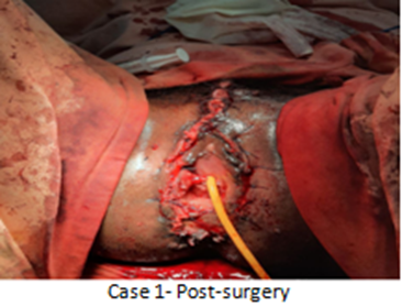 Figure 2: Case 1 posts –surgery.