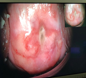 Figure 1: Ectocervix with hemorrhagic, fibrinous, exudative appearance, Colposcopic examination.