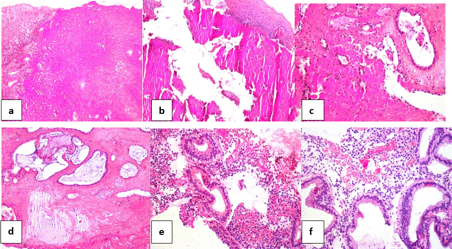 Figure 2: a) Ectoservical squamous epithelium (upper left corner), dense fibrinous material, HE, X100, b) Ectoservical squamous epithelium (upper right corner), fragmente fibrinous material, HE, X100, c) Endoservical glandular tissue (upper), fibrinous material, HE, X100, d) Fibrin and inflammatory cells that integrate with the endocervical glandular tissue, HE, X200, e) Fragmented endometrial stromal-glandular tissue mixed with fibrinous material, HE, X100 f) Endometrial glandular-stromal tissue, fibrinous material (upper), HE, X200.