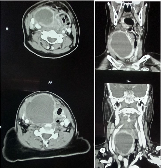 Figure 1: CT Neck with contrast showing well defined cystic lesion measured about 6.6* 5.9*5 cm in the right lobe of the thyroid surrounding with inflamed fat and multiple enlarged lymph nodes bilaterally.