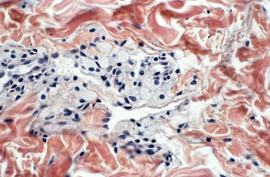 Figure 1: Xanthelasma depicting clusters of lipid laden histiocytes and foamy macrophages accumulated within the dermis and surrounding vascular structures [7].