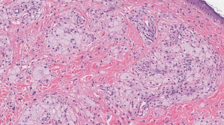 Figure 2: Xanthelasma delineating aggregates of lipid laden histiocytes and foamy macrophages accumulated within the dermal region and circumscribing blood vessels [8].