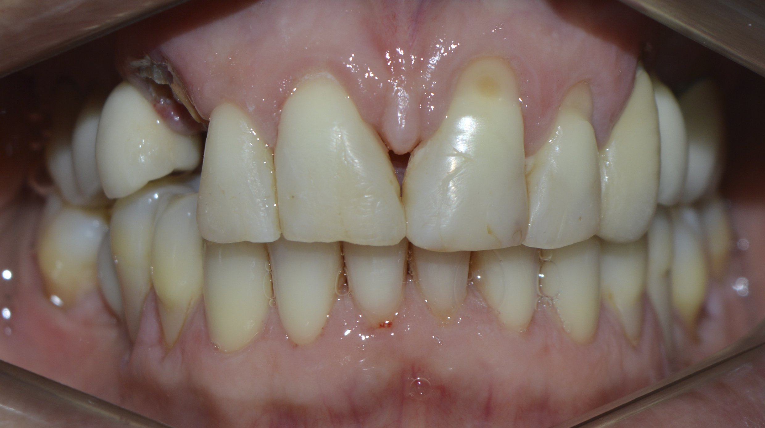 Figure 1: Upper right canine fractured at the cervical level (frontal view).