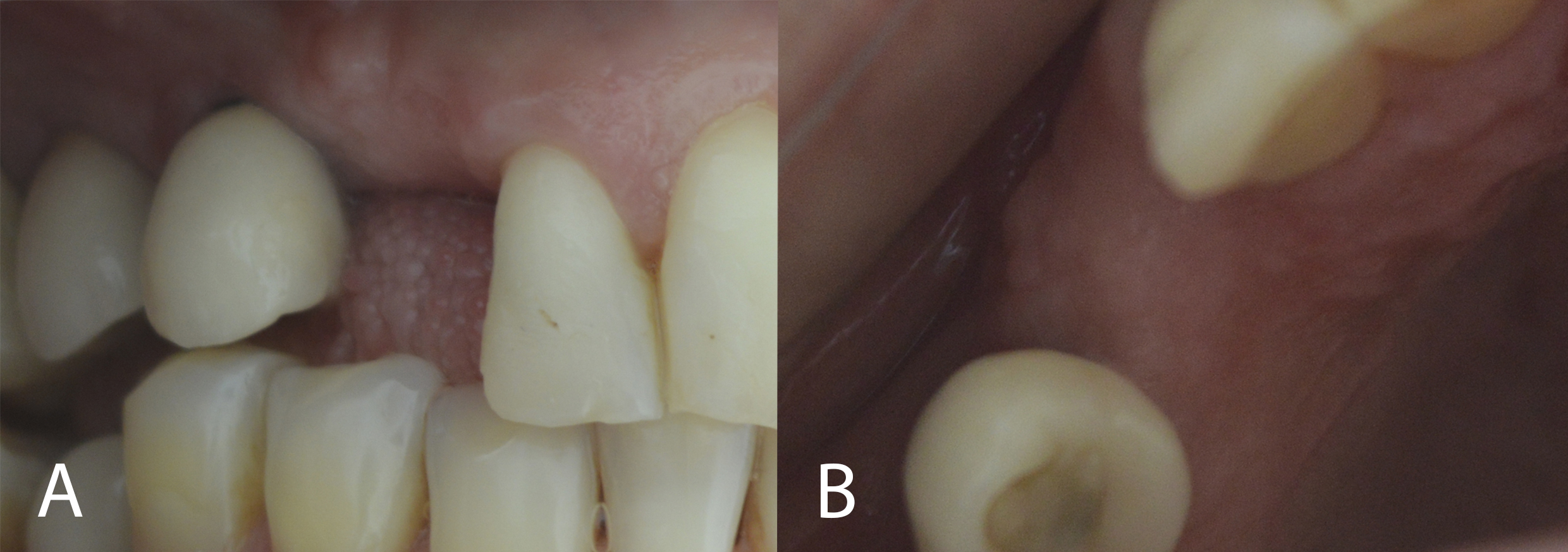 Figure 10: Clinical evaluation (8 months): bone thickness maintenance of gingival tissue (A: right lateral view; B: occlusal view).