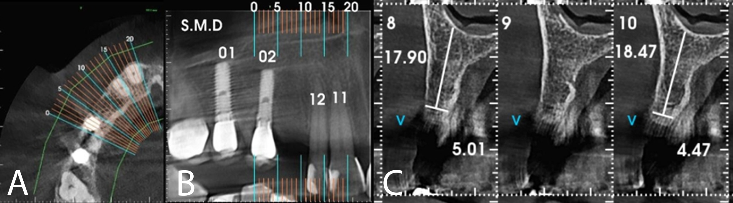 Figure 11: CTCB showing preservation of mature, healthy bone tissue.