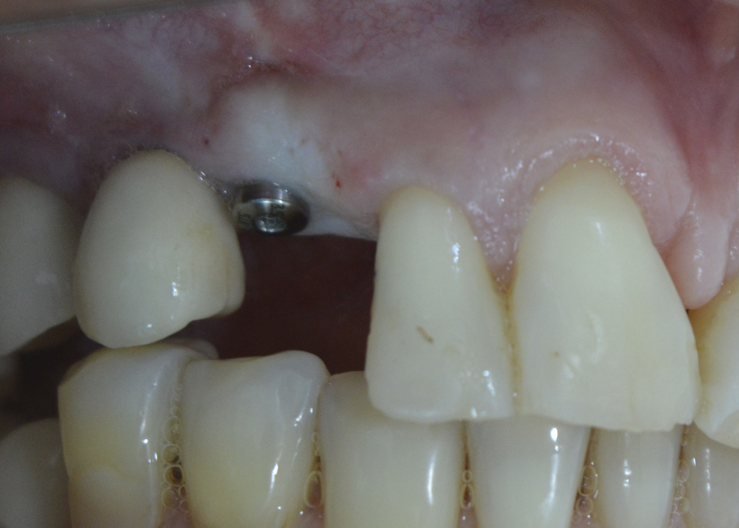 Figure 12: Instalation of the healing abutment.