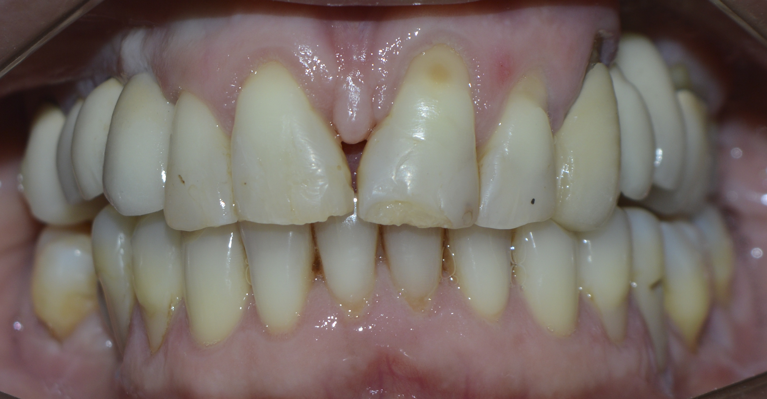 Figure 13: Instalation of the porcelain prosthesis (frontal view).