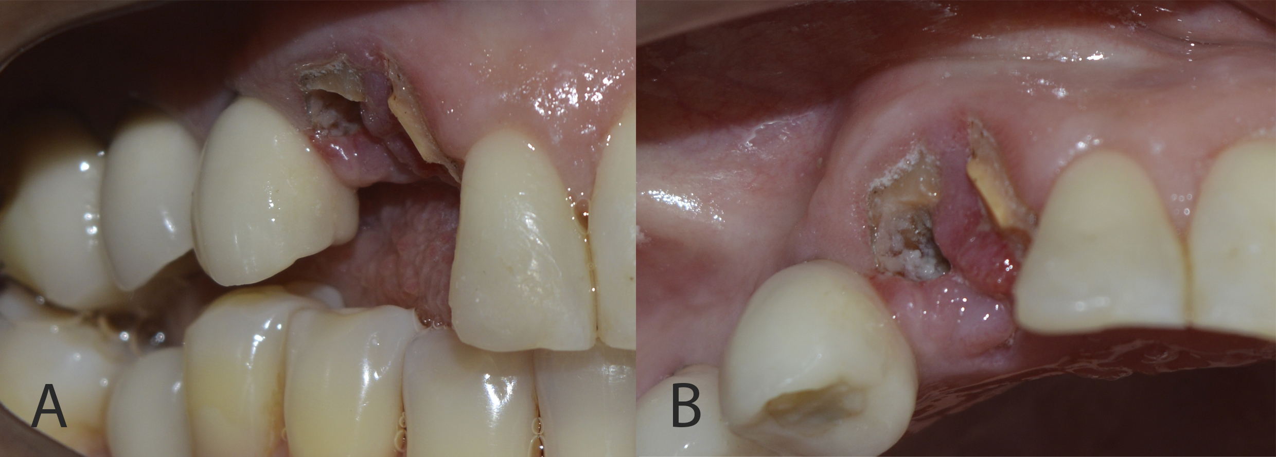 Figure 2: Root remnant showed caries and inflamed adjacent gingival tissue (A: right lateral view; B: occlusal view).