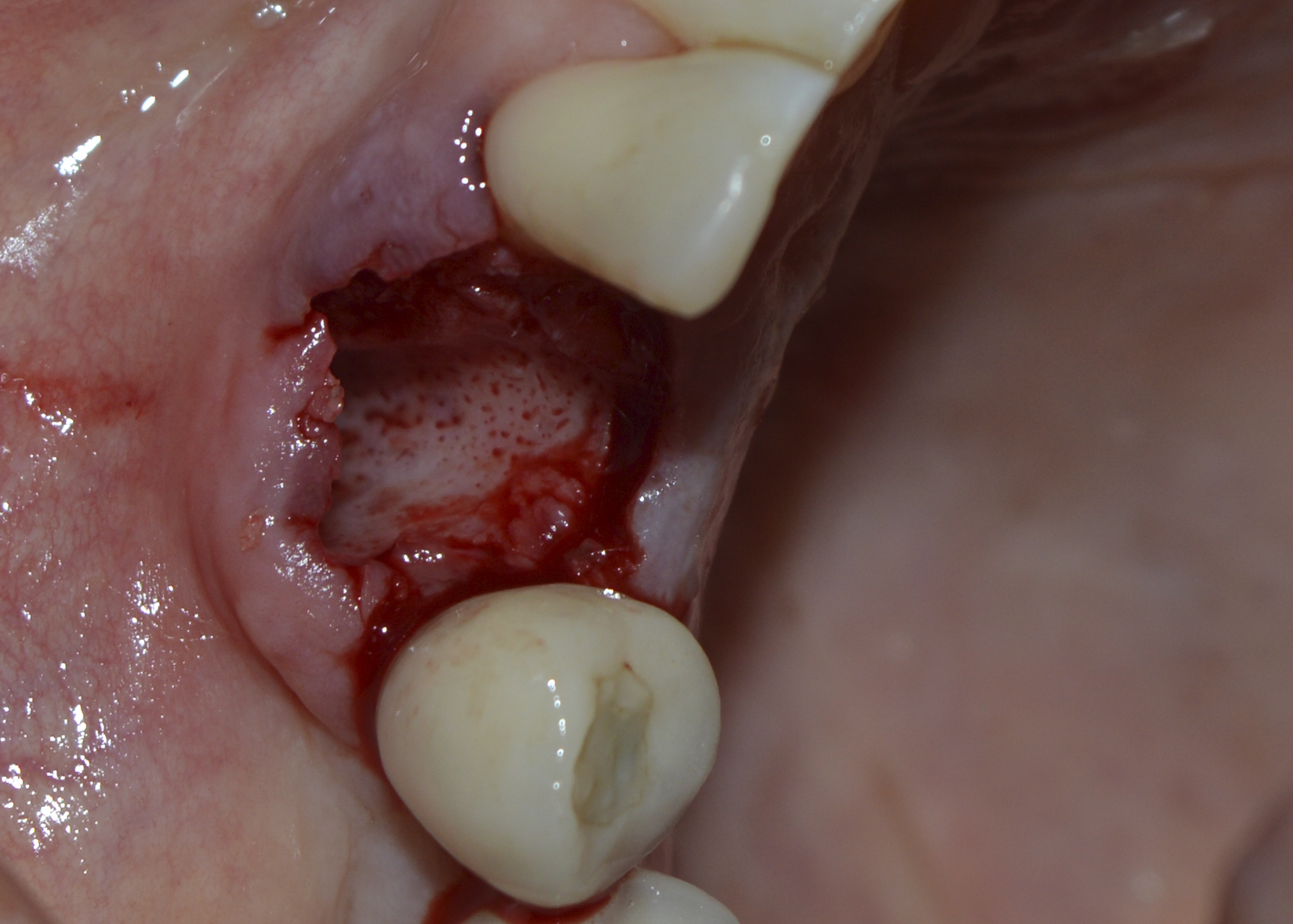 Figure 4: Socket after extraction, curettage and washing with saline solution. Observe bleeding points.