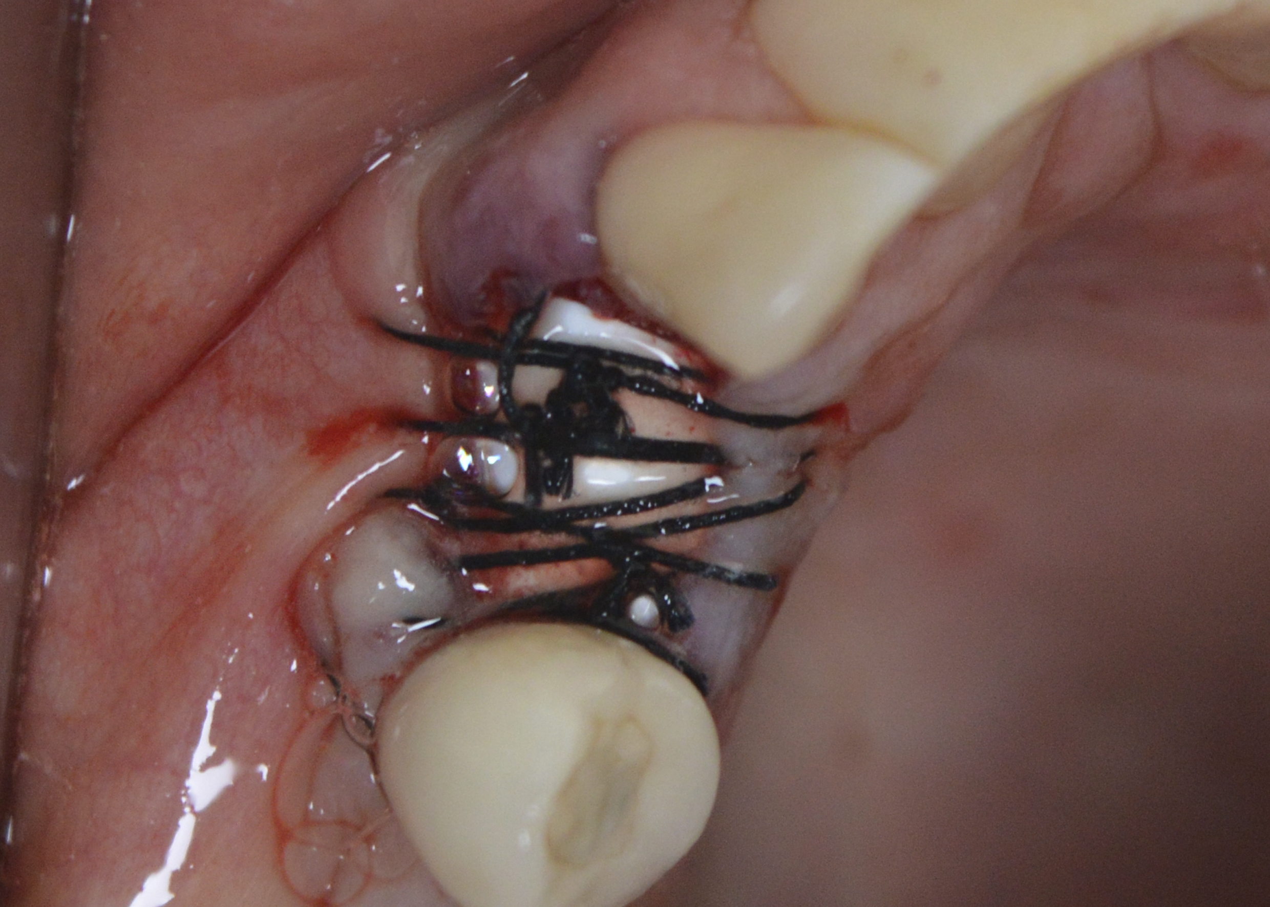 Figure 5: Polypropylene membrane installed over the socket and under the sutures.