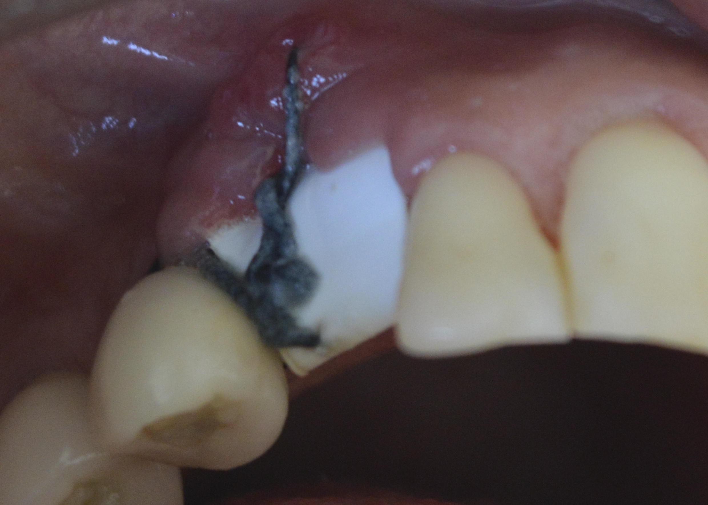 Figure 7: Post-operative evaluation (15 days): removal of the remaining sutures and the polypropylene membrane.