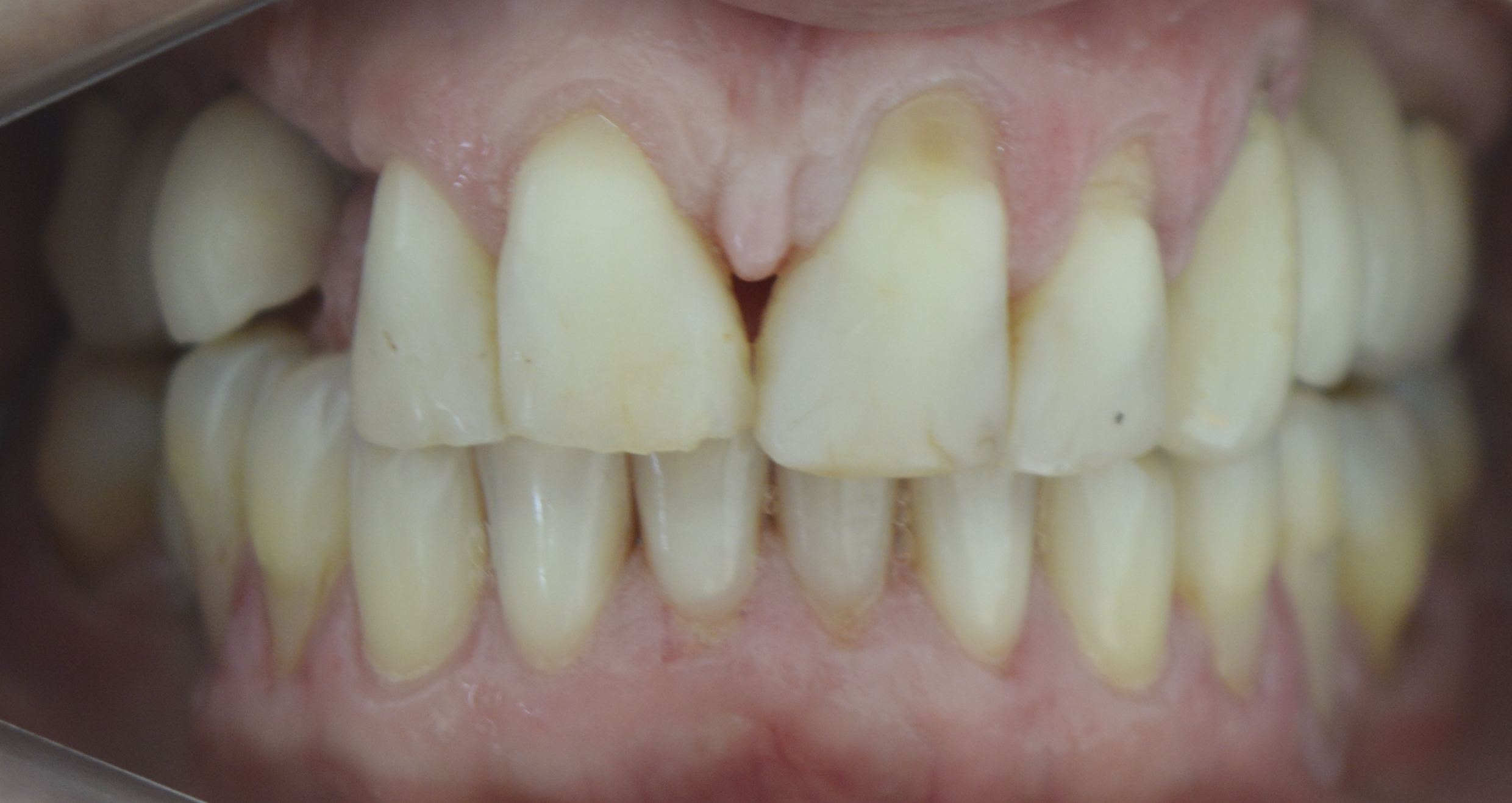 Figure 9: Clinical evaluation (8 months): bone thickness maintenance of gingival tissue (frontal view).