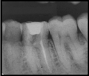 Figure 3: After Gutta Percha removal.