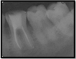 Figure 4: Post Operative Radiograph.