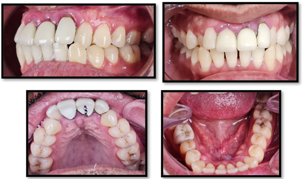 Figure 1: A: Old prosthesis 11-22, B: Severe gingival inflammation around the old prosthesis and bilateral canine crossbite C: Maxillary 
arch, D: Mandibular arch