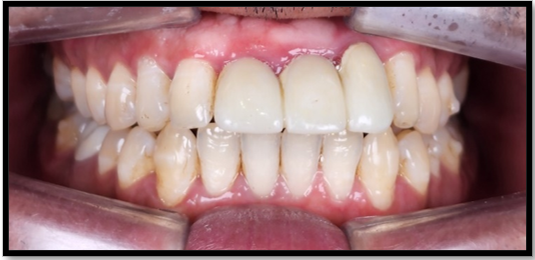 Figure 2: PMMA given after periodontal treatment completion.