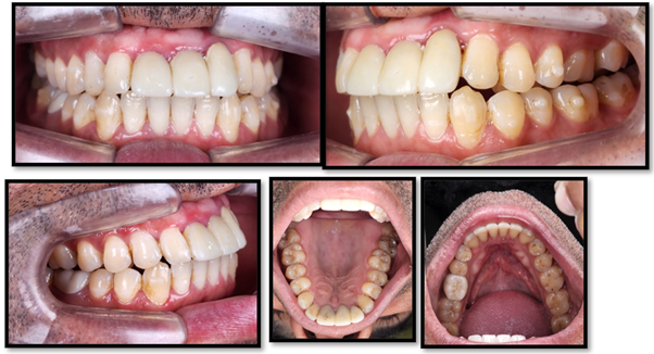 Figure 3: Functional occlusion achieved after orthodontic treatment with clear aligners (Flexismile, India) A: Centre, B: Right, C: Left, D: 
Maxillary, E: Mandibular