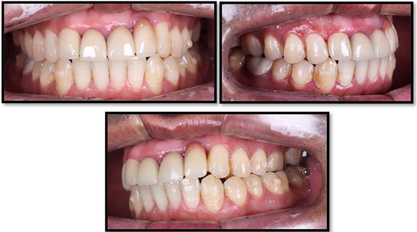 Figure 4: Post treatment. A: Centre, B: Right, C: Left.