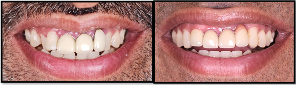 Figure 5: A: Pre-treatment smile, B: Post treatment smile.