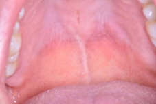 Figure 1: Increased soft volume in the hard palate on the left side close to the border with the soft palate.