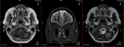 Figure 2: The report describing the MRI mentions Tl hypointense, T2 hyperintense, defined contour, cystic-looking structures on the roof of the palate bilaterally, approximately 16 x 6 mm, non-specific.