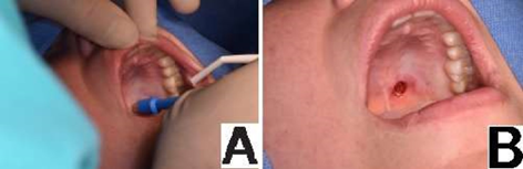 Figure 3: A) Obtaining biopsy with 5mm Tissue PUNCH. B) Surgical biopsy site.