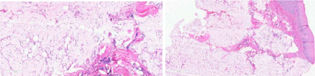 Figure 4: Histological sections. Minor salivary gland acini with conservation of architecture and with extensive associated necrosis, the acinar cells present pyknotic nuclei with effacement of cell boundaries and extravasation of mucin, associated with cellular debris.