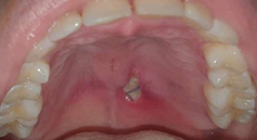 Figure 5: 5-day post-biopsy control. Extension of biopsy bed margins with surrounding tissue with normal clinical characteristics. Self-limiting necrotic tissue is observed within the bed.