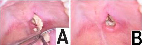 Figure 6: A - B. 2-week post-biopsy control. A) The presence of solid yellowish-white tissue compatible with necrotic tissue is observed in the biopsied area. B) The bottom of the biopsied area is observed covered by a layer of fibrin compatible with a normal healing process.