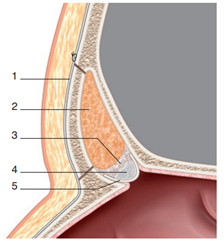 Figure 3: 1. Sutured periosteum; 2. Fat; 3. Biological adhesive; 4. Bone graft; 5. Pericranial or aponeurosis graft.