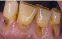 Figure 2: Abrasion.