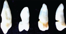 Figure 3: Showing various degrees of tooth wear.