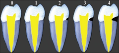 Figure 4: Showing tooth wear index.