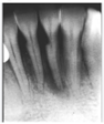 Figure 5: Radiographic view of abrasion.