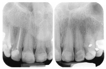 Figure 6: Radiographic view of Erosion.