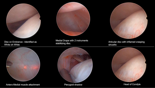 Figure 4: Various landmarks and tissue representation visible in arthroscopy.