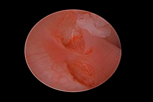 Figure 5: Tear visible in retrodiscal areas which was placed between the bony articular surfaces.