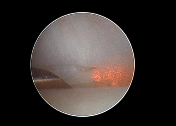 Figure 6: Laser myotomy releasing the anteromedial pull of superior lateral pterygoid muscle.