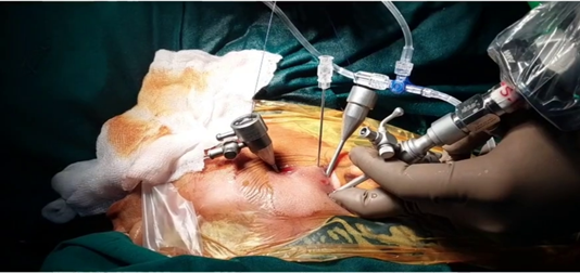 Figure 7: 3 Port access holes and 1 Spinal needle along with 2-0 PDS suture.