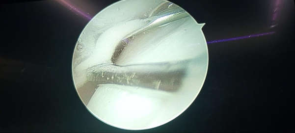 Figure 9: Colloid of kenacort injection under vision injected in superior joint space.