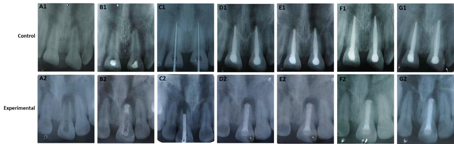 Figure 2: The radiographs of apical closure induction by Ca (OH)2 (control) and MTA (experimental). The radiographs (A1-G1) indicated the teeth treated by Ca (OH)2 and the radiographs (A2-G2) indicated the teeth treated by MTA. In control group: (A1 = initial X-ray; B1 = after placement of Ca (OH)2paste; C1 = 2 mm apical barrier formation; D1 = obturation by vertical compaction; E1 = follow up after 3 months; F1 = follow up after 6 months; G1 = follow up after 12 months). In experimental group: (A2 = initial X-ray; B2 = after placement of MTA paste; C2 = trial of custom made plugger; D2 = obturation by vertical compaction; E2 = follow up after 3 months; F2 = follow up after 6 months; G2 = follow up after 12 months).