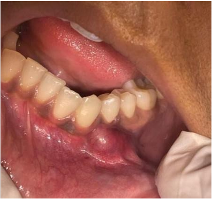 Figure 1: Asymptomatic nodule in the left mandibular mucosa.